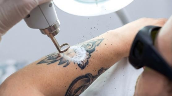 Enlever tatouage Enlever tatouage
