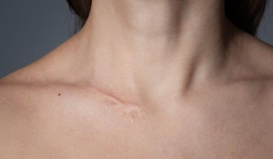 Cicatrice et imperfection Cicatrice et imperfection