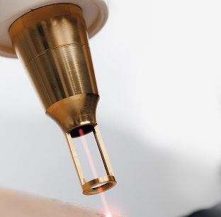 Des soins laser encadrés avec attention
